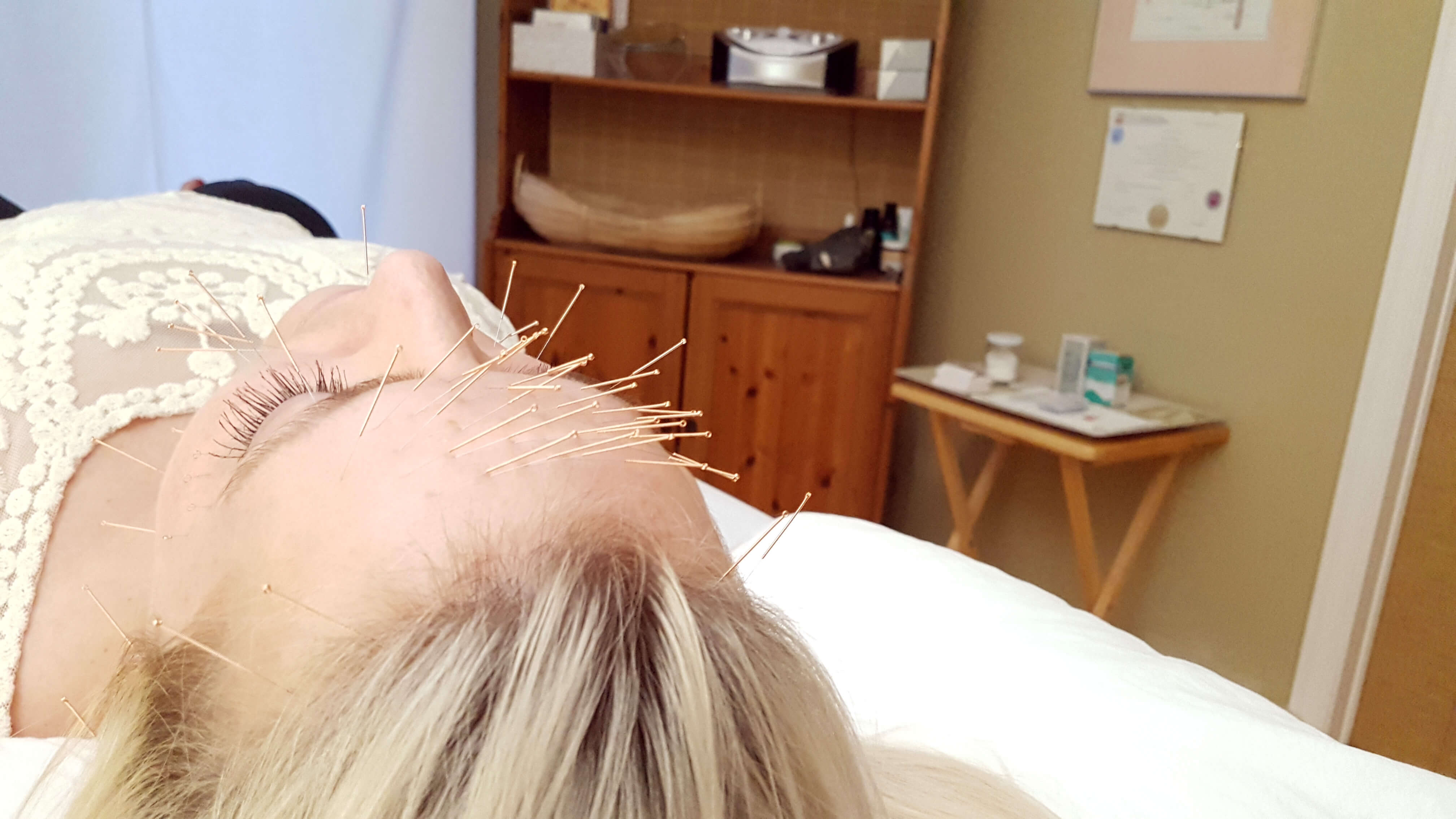 Actual client receiving cosmetic facial rejuvenation acupuncture at Harmony Acupuncture Kanata, Ottawa